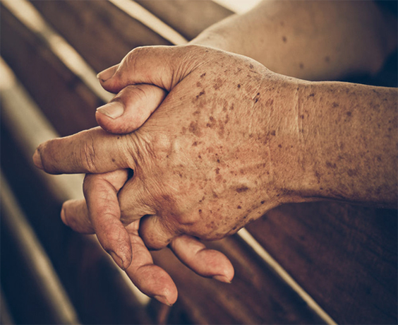 Cách chữa bệnh đồi mồi