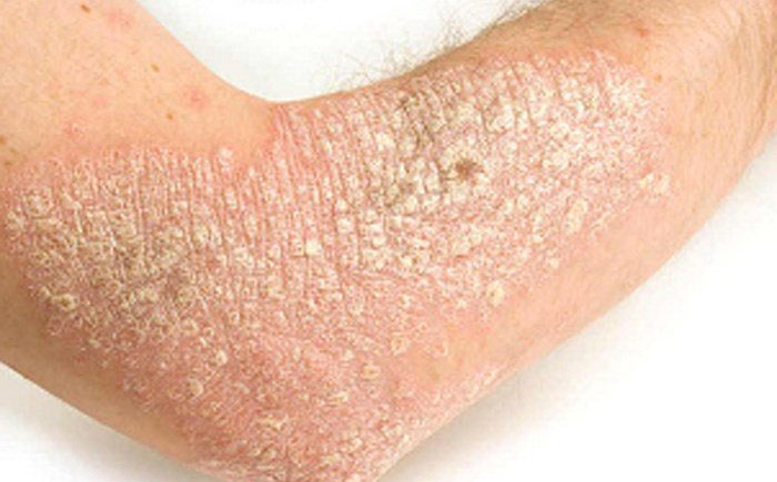 Vảy nển xuất hiện ở tay