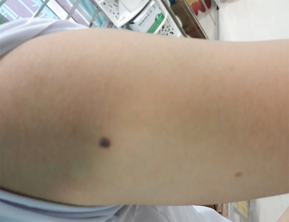 Laser điều trị nốt ruồi