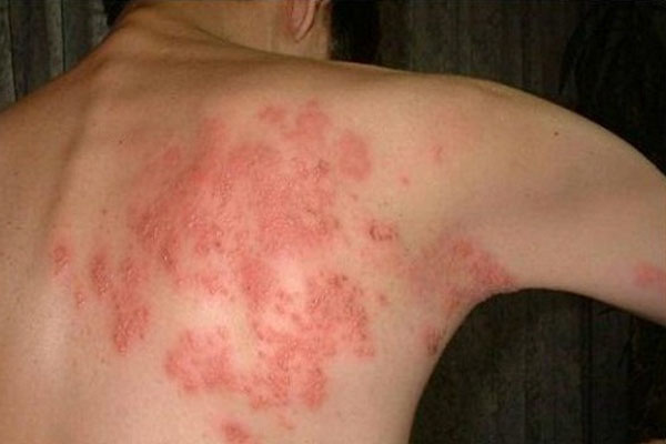 Zona thần kinh ở lưng