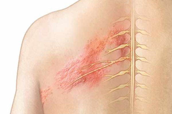 Biểu hiện bệnh Zona thần kinh