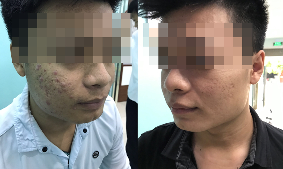 Nam thanh niên trị mụn trứng cá