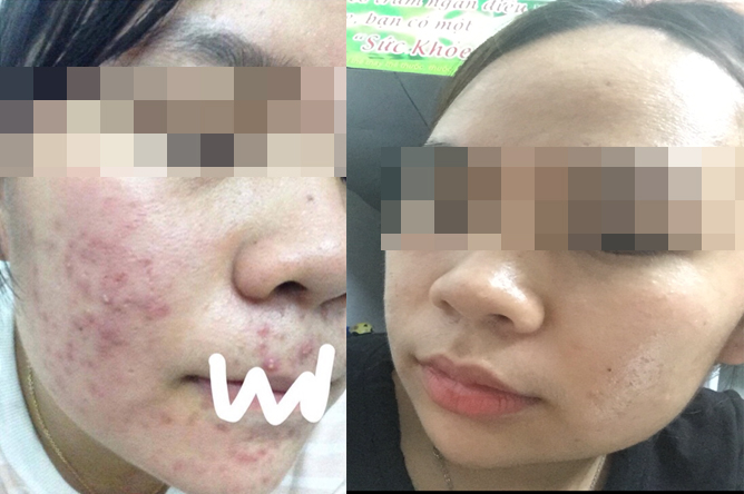 Các bạn nữ tự tin sau liệu trình trị mụn trứng cá