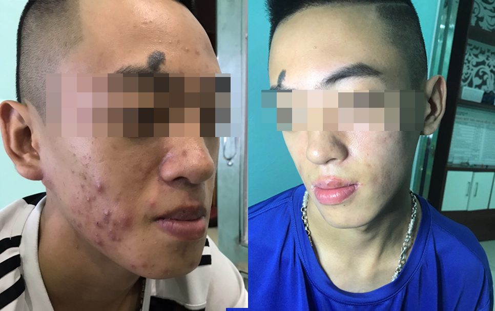 Khách hàng nam trị mụn trứng cá