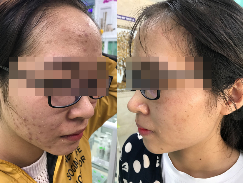 Khách hàng nữ tự tin sau liệu trình trị mụn trứng cá