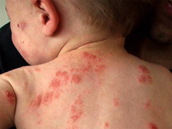 Viêm da mủ trẻ sơ sinh