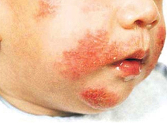 Trẻ viêm da dị ứng