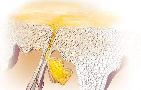 Sự tăng tiết bã nhờn