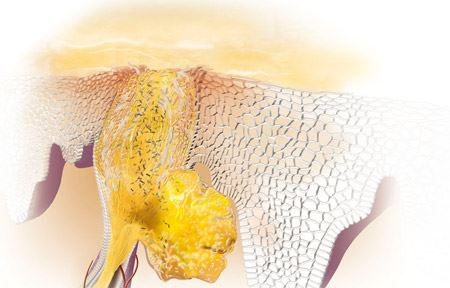 Vi khuẩn cư trú trong nang lông tuyến bã
