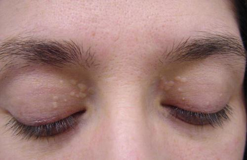 Bệnh u tuyến mồ hôi