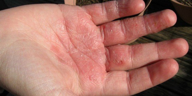 Bệnh viêm da cơ địa