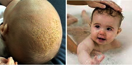 Viêm da đầu ở trẻ