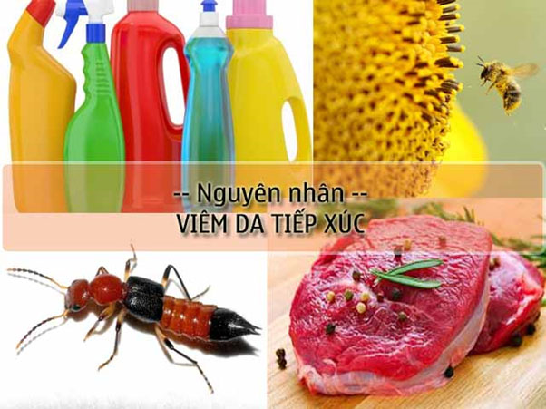 Nguyên nhân gây nên viêm da tiếp xúc